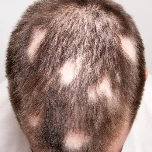 Alopecia areata